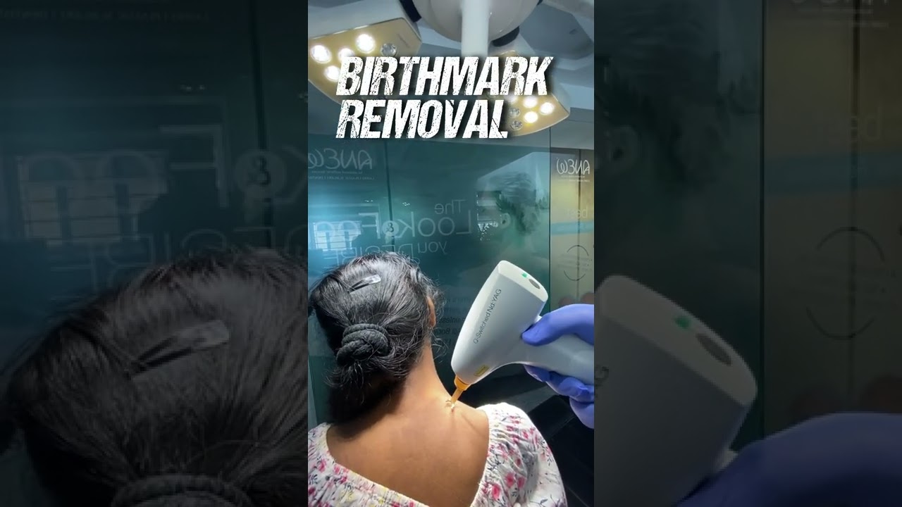 Birthmark Removal | Laser treatment | Anew Aesthetic Clinic | Bangalore