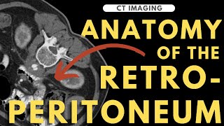 Retroperitoneal anatomy, organs and spaces | Radiology anatomy part 1 prep | CT abdomen screenshot 5