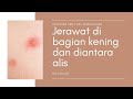 Jerawat Keras Kepala di Ujung Kening: Atasi dengan Tepat!
