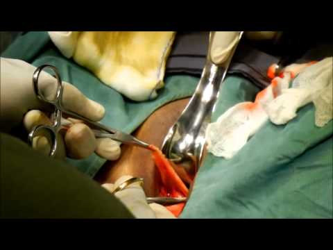 elective vaginal surgery Labiaplasty is a cosmetic procedure which reduces the size of the labia labiaplasty is one of several specialized procedures in cosmetic vaginal surgery. elective vaginal surgery Labiaplasty is a cosmetic procedure which reduces the size of the labia labiaplasty is one of several specialized procedures in cosmetic vaginal surgery.