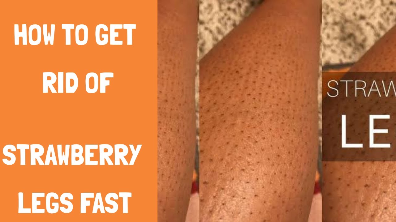 #strawberrylegs #keratosisPilaris HOW TO GET RID OF STRAWBERRY LEGS - YouTube