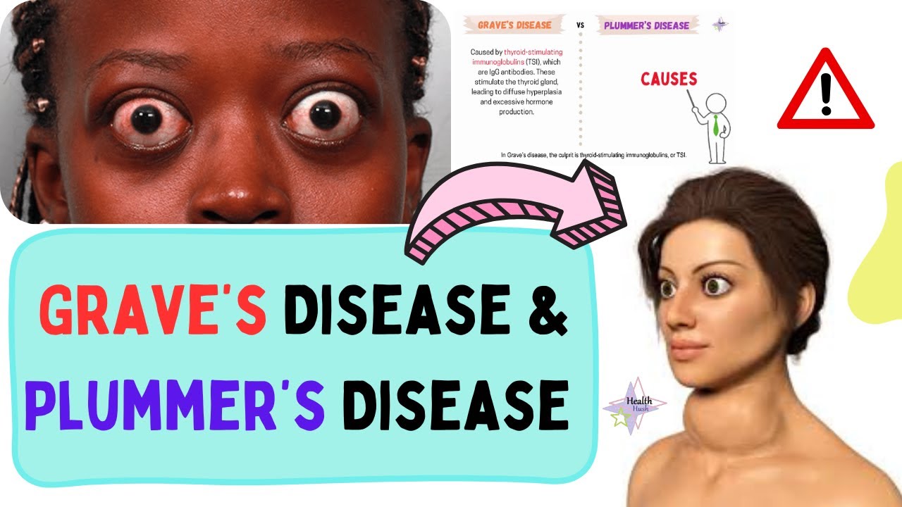 Grave's Disease vs. Plummer's Disease: What's the Difference? - YouTube