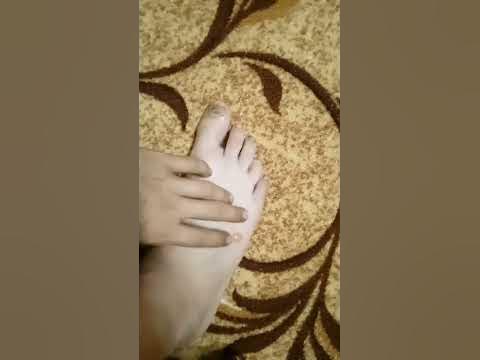 большой волдырь - YouTube