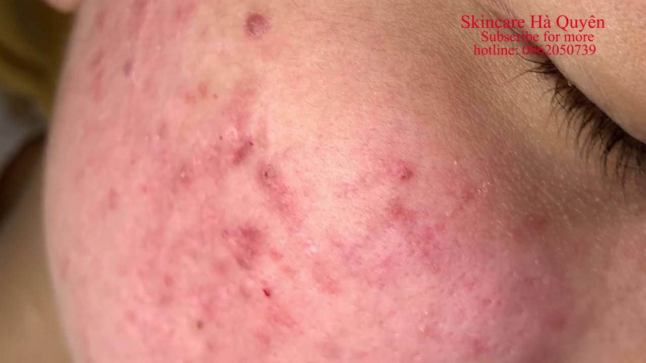 Blackheads and Acne treatment in Ha Quyen Spa on 04/02/2020 - Điều trị mụn tại Hà Quyên spa