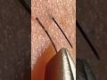 #ヒゲ抜き　#髭抜き　　#埋没毛　#癒し　　#気持ちいい　#ストレス発散　#髭　#スッキリ　#tweezers #pinça #चिमटी #pinset #пинцет #털이
