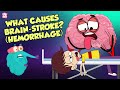 What Causes A Brain Stroke? | Brain Attack | The Dr Binocs Show | Peekaboo Kidz