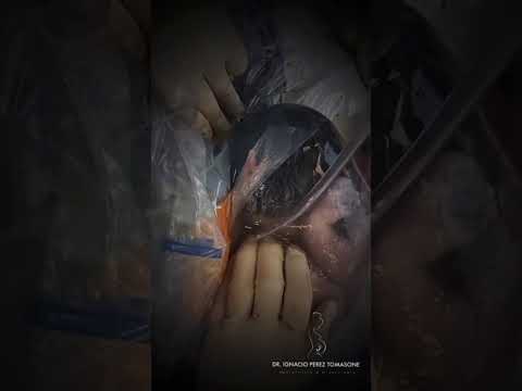 נפלאות הבריאה תינוק יצא לאוויר העולם כשהוא עדיין עטוף בשק מי שפיר שנותר ללא פגם 