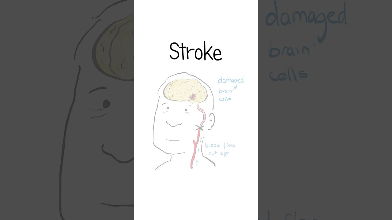 Strokes Explained Healthsketch Shorts