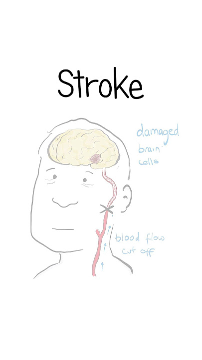 Strokes Explained #healthsketch #shorts