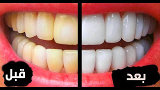 وصفات لتبييض الاسنان وازاله الرائحه الكريهه من الفم