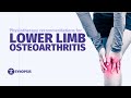 Recommendations for Managing Lower Limb Osteoarthritis | SYNOPSIS