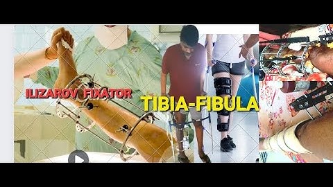 Tibia fracture #gaint training #knee Range of motion exercise #ilizorov fixtore