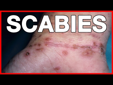 How To Deal With Scabies Or Crusted Scabies // Treatment, Cure, Signs And Symptoms