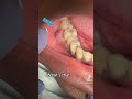 Periodontal Abscess Periodontal Abscess