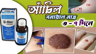 D Film Solution Uses || Warts/আঁচিল দূর করুন মাত্র ৩ দিনে ||