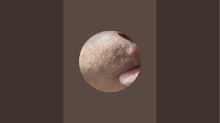 Ingrown hairs zone .6 is live#ingrownhair #oddlysatisfying #oddlysatisfyingvideo #satisfying #asmr