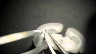 Dissection of the DG
