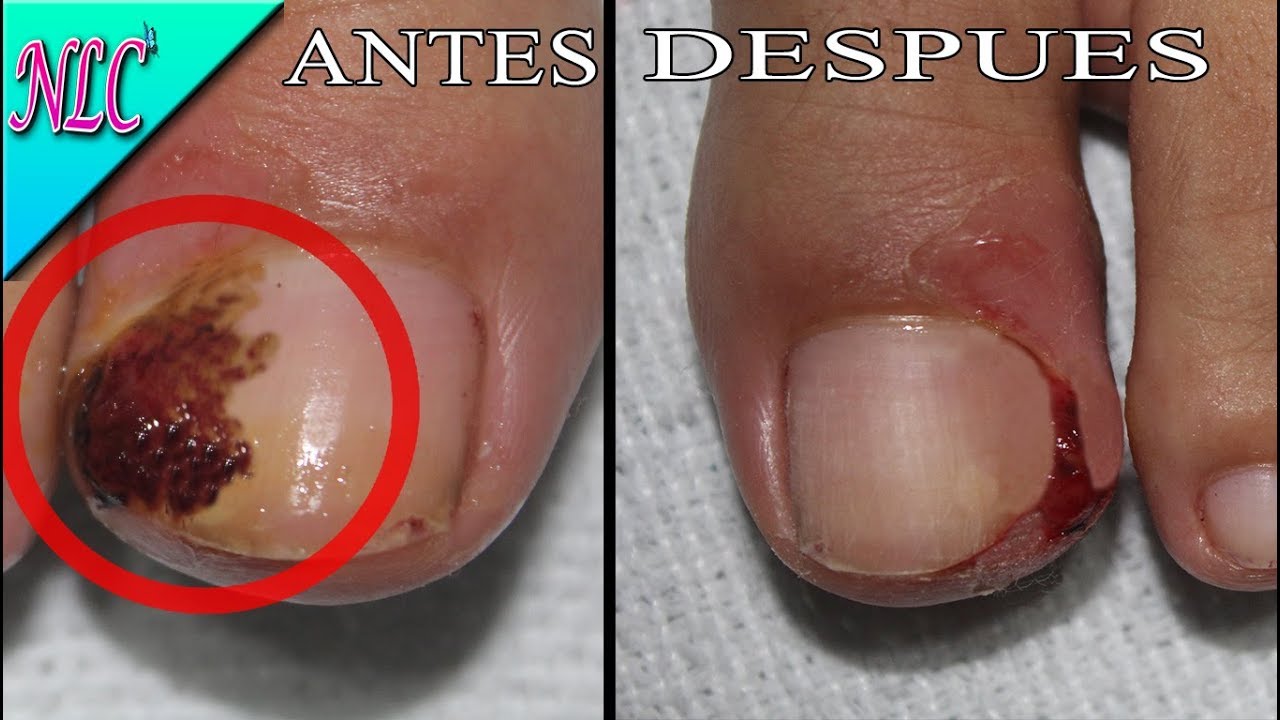 COMO SACAR UÑA ENCARNADA EN LOS PIES ¡SIN DOLOR! - SACAR UÑA ENCARNADA