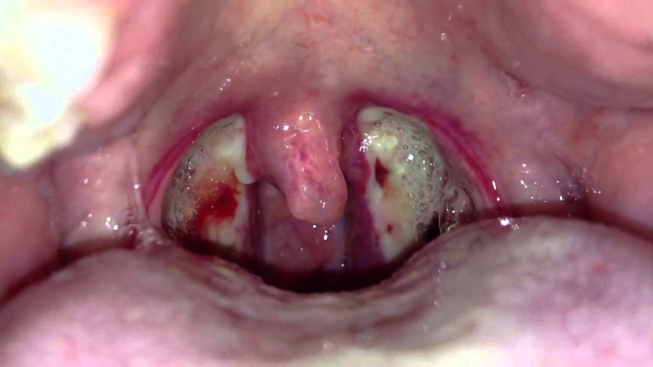 Tonsil Stones