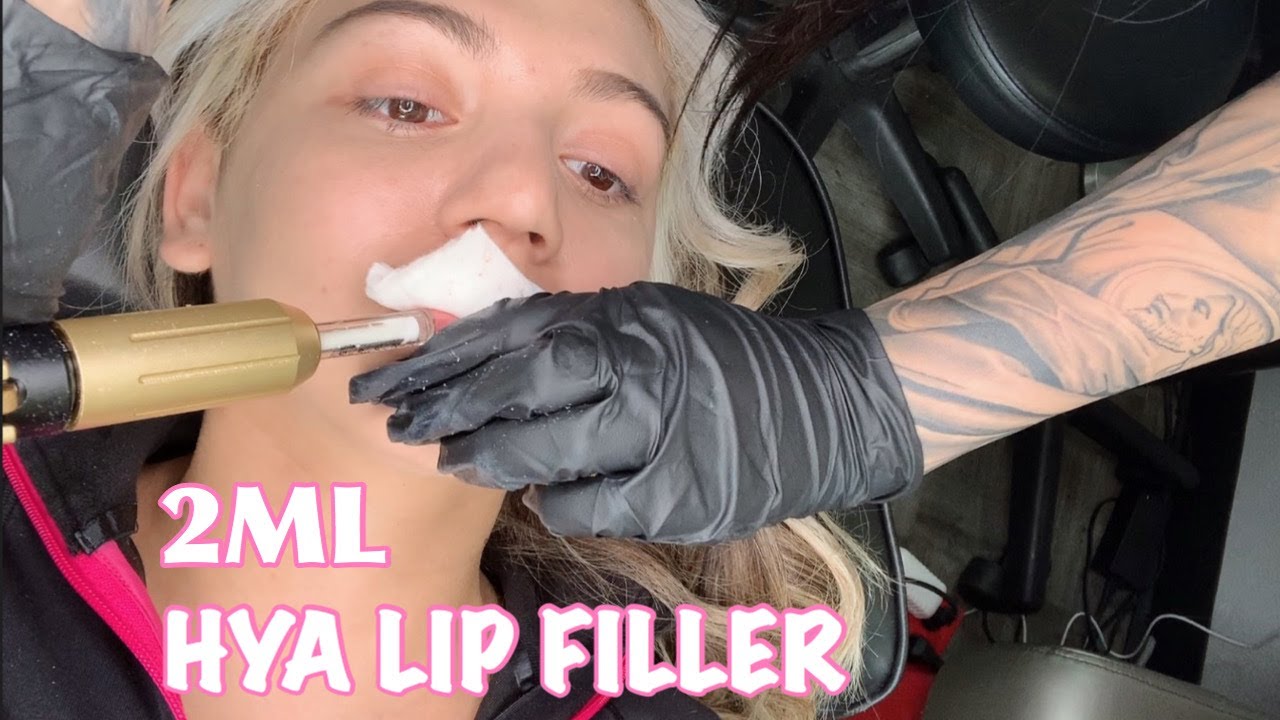 I GOT HYLURON LIP FILLERS NO NEEDLE YouTube
