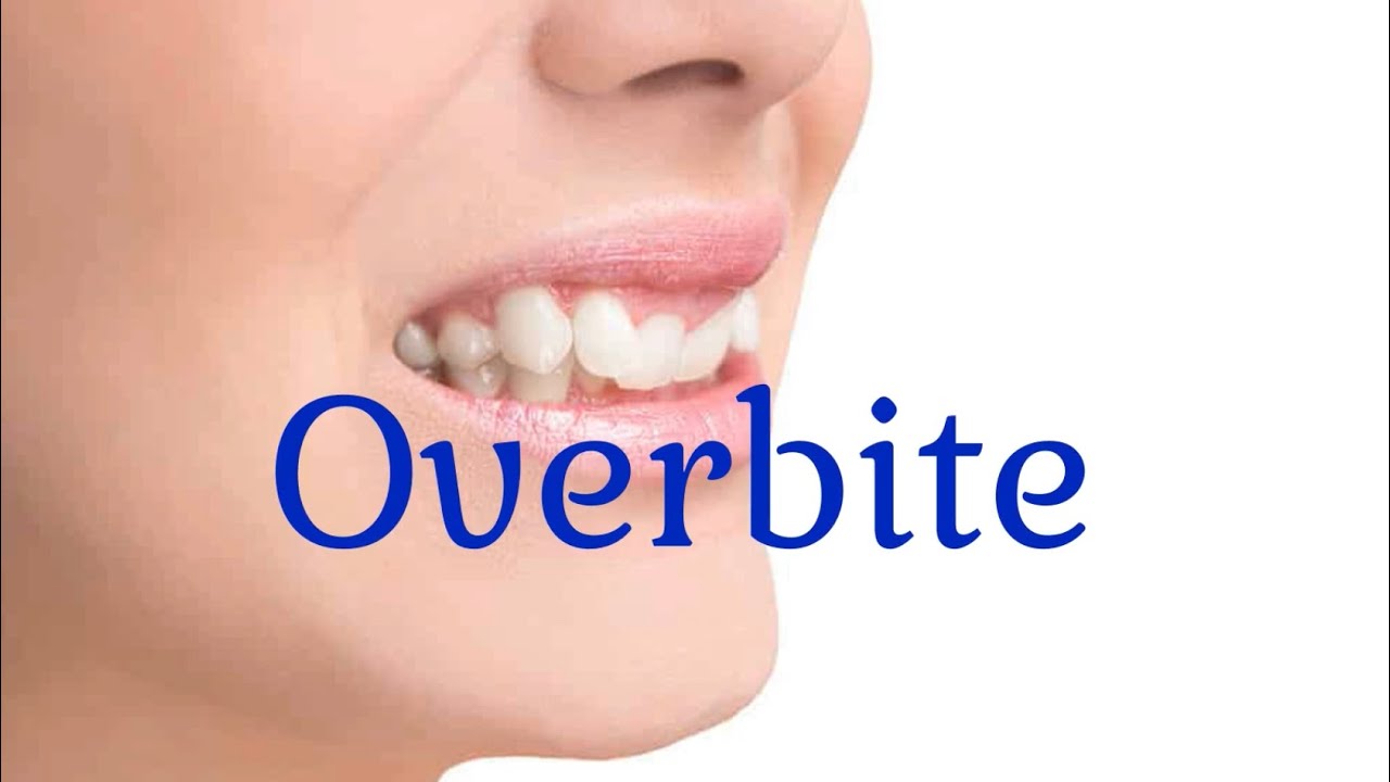 How an Overbite Affects Your Smile & Health