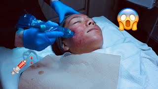 First time getting microneedling! + Results