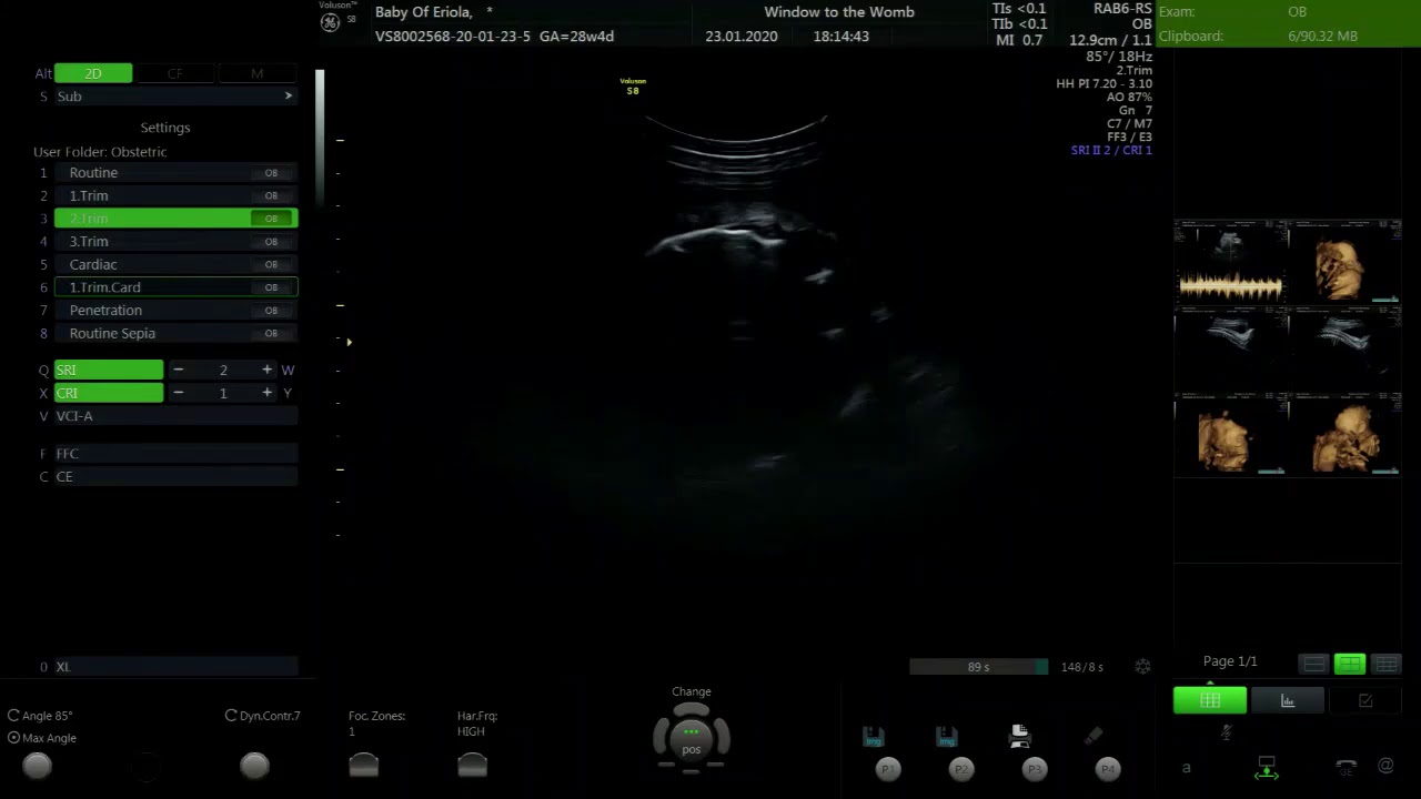 HD 4D Scan 28 weeks Window to The Womb - YouTube