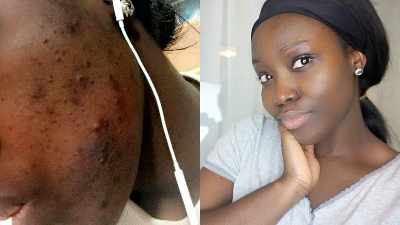 HOW I CLEARED MY ACNE (Skincare Daily Routine