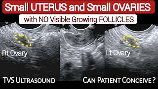 Small Uterus and Small Ovaries - with No Visible Growing Follicles - TVS Ultrasound