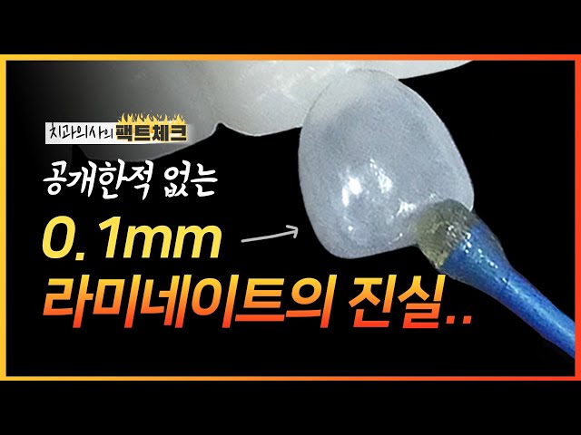 무삭제 라미네이트, 얇을수록 좋을까❓ | 라미네이트의 진실🦷