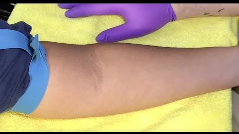 Tips For Locating Difficult Veins - DayDayNews