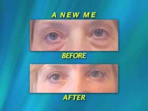 virginia-area-plastic-surgeon-shares-amazing-cheek-lift-results