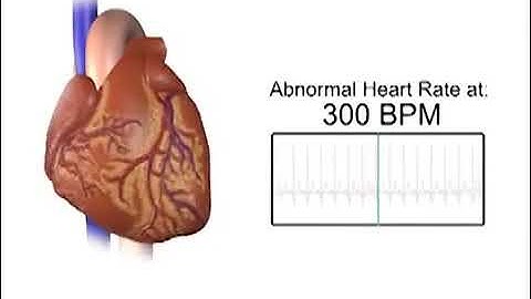 Heart Beatin at 300 BPM