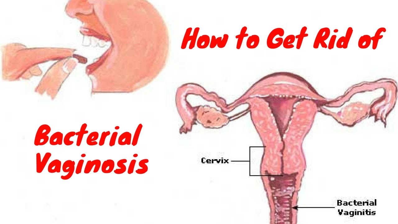 How To Get Rid Of Bacterial Vaginosis Youtube