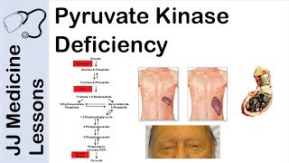 Pyruvate Kinase Deficiency | Symptoms, Pathophysiology, and Treatment