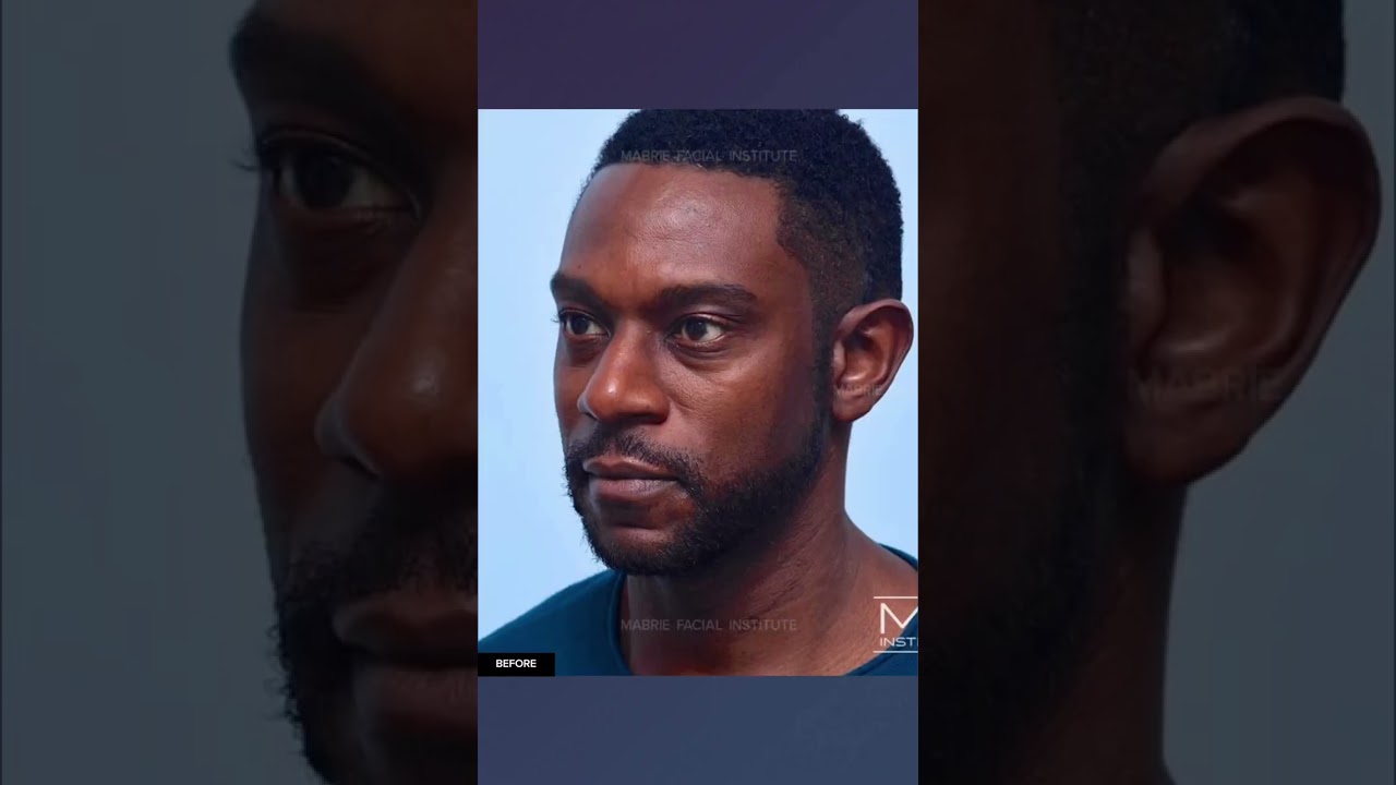 From BroTOX to Fillers...