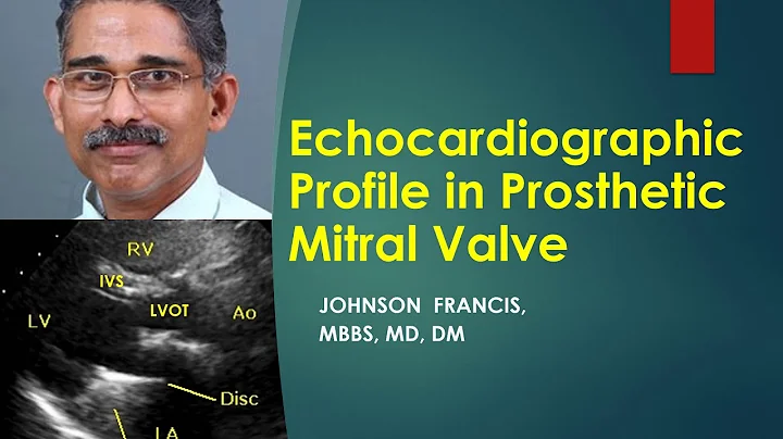 Echocardiographic profile of prosthetic mitral valve