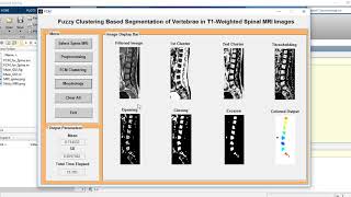 Fuzzy Clustering based Segmentation of Vertebrae in T1 Weighted Spinal MRI Images MATLAB Code
