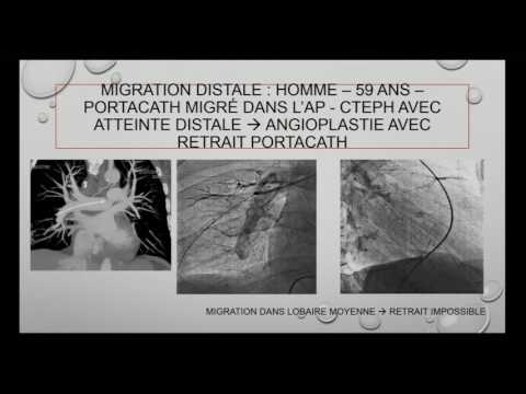 13 Comprendre les échecs de retraits corps étrangers - Dr Philippe Brenot