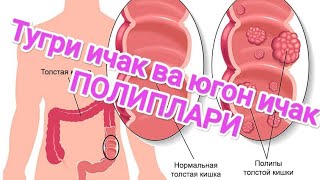 видео: Тугри ичак ва югон ичак Хавфсиз усмаси-ПОЛИПЛАР. Куриниш геморройга ухшаш аммо умуман бошка касаллик картинка: Тугри ичак ва югон ичак Хавфсиз усмаси-ПОЛИПЛАР. Куриниш геморройга ухшаш аммо умуман бошка касаллик