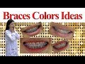 Braces Colours Ideas!