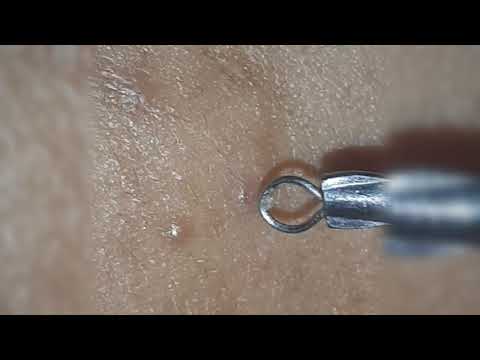 Whitehead Removal Sample 1