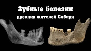 Зубные болезни древних жителей Сибири