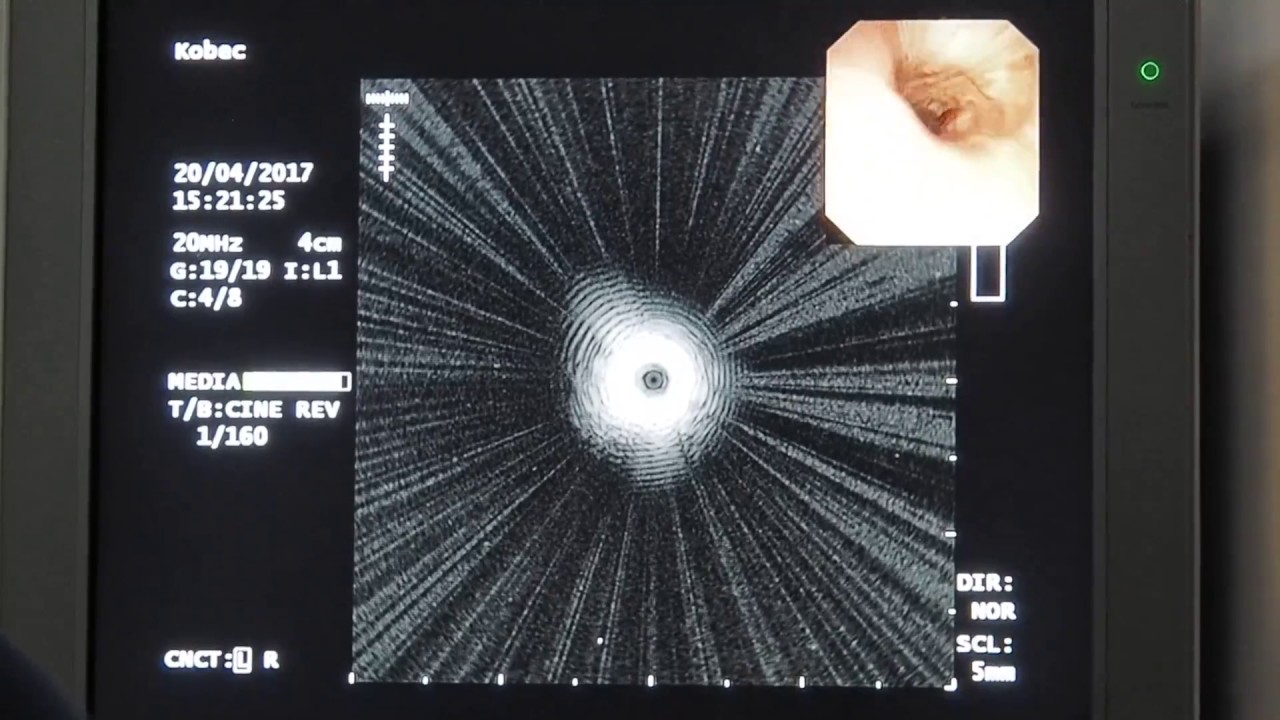 04 Соколов СА Бронхоскопия, pEBUS биопсия Рак легкого OLYMPUS