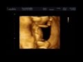 13 weeks pregnancy. Ultrasound. 13 недель беременности. 3D