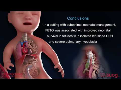 UOG Journal video abstract on the role of FETO in improving the outcome of fetuses with CDH