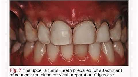 Bench Mastery: VITA VM 9 for an Anterior Restoration