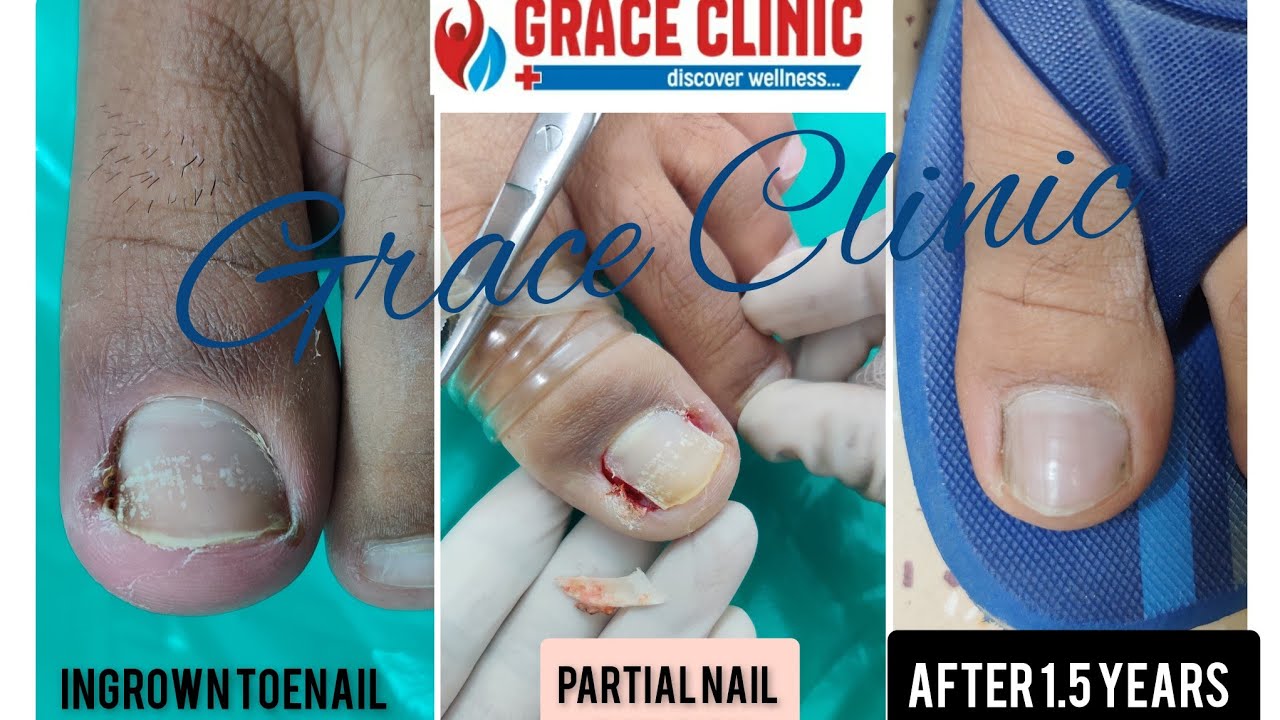 Ingrown Toenails - Podiatrist in Hamden, CT | CT Family Foot Care and  Surgery
