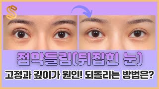 점막 들림뒤집힌 눈, 쌍꺼풀 고정과 깊이가 원인! 다시 되돌리는 방법은??