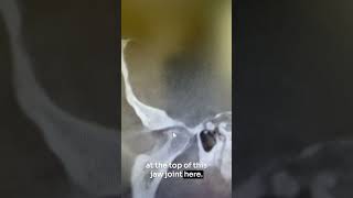 Shocking Truth: Jaw Problems Linked To Hearing Loss #shorts